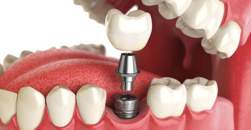 Glyde 2 Siringhe Puntali Dentsply Sirona - Foto 5