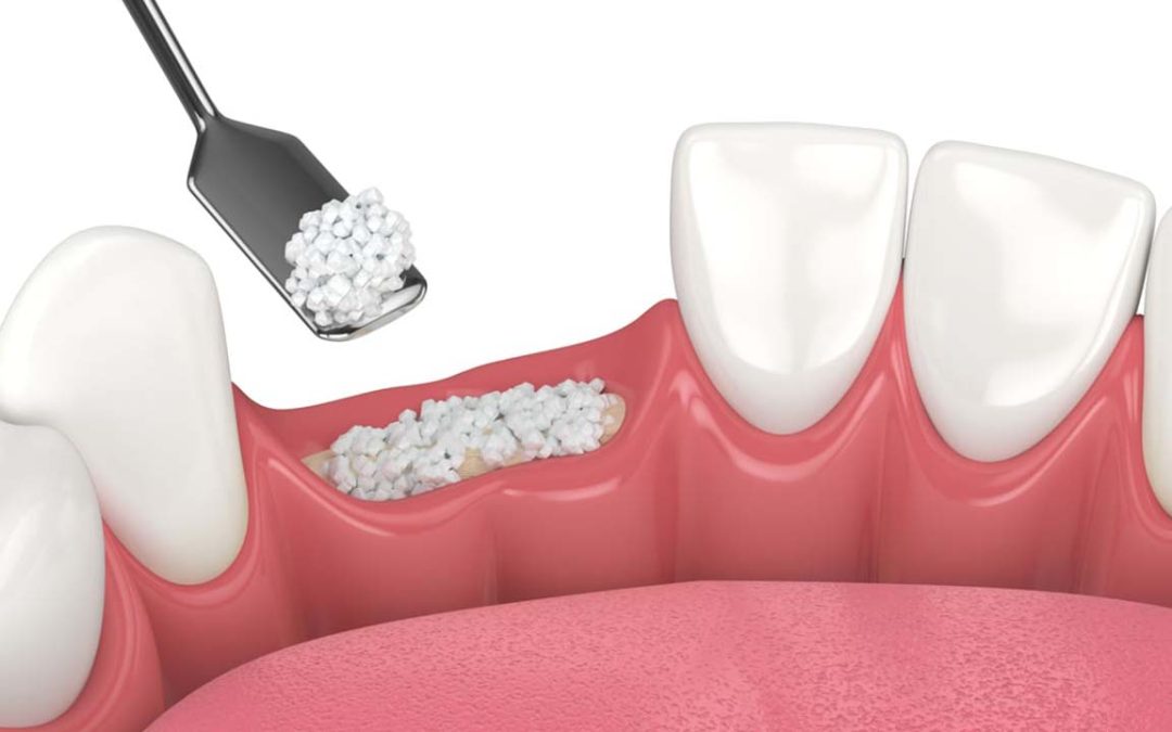 Rigenerazione ossea autologa: Il ruolo del Tooth Transformer nell’odontoiatria moderna