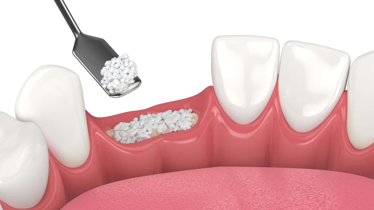Innesto Osseo Dentale – Studio dentistico Fiammenghi Innesto Osseo Dentale - Studio dentistico Fiammenghi