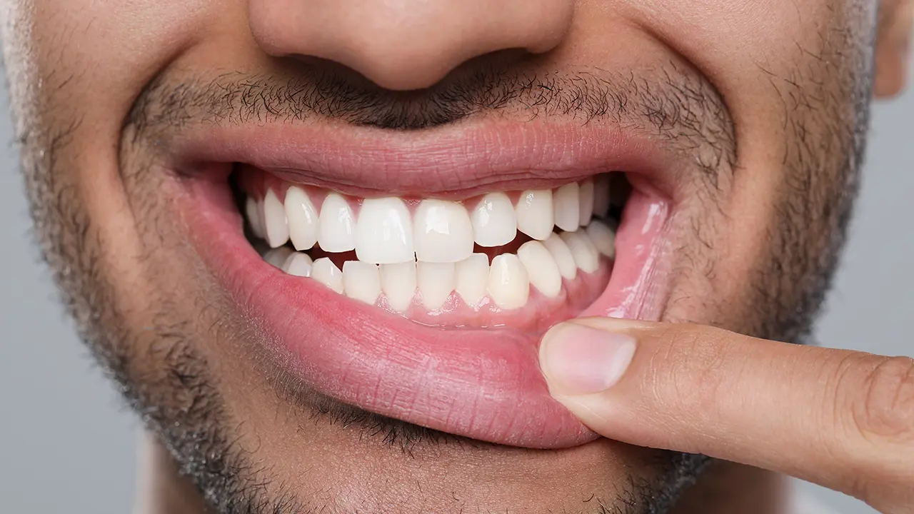 Perché Mantenere le gengive sane previene la perdita dei denti – Studio Fiammenghi – Dentista Perché Mantenere le gengive sane previene la perdita dei denti - Studio Fiammenghi - Dentista
