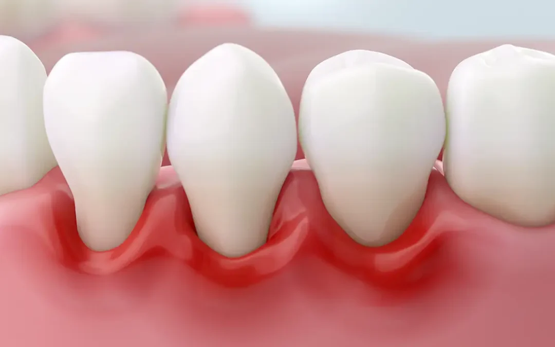 Come Riconoscere i Sintomi della Parodontite