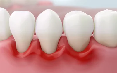 Come Riconoscere i Sintomi della Parodontite