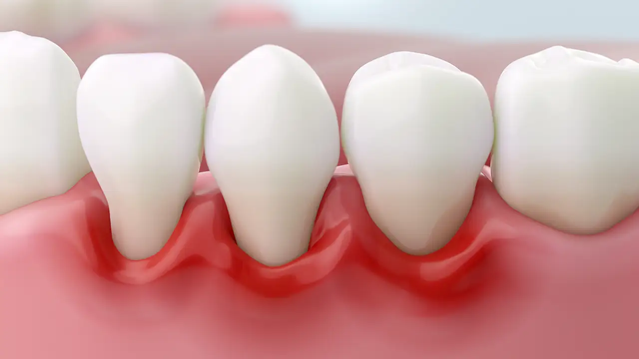 Come Riconoscere i Sintomi della Parodontite - Studio Fiammenghi - Dentista