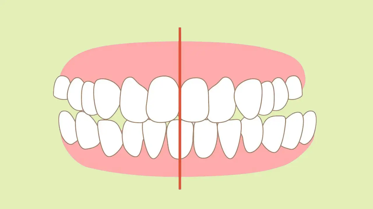 Il Morso inverso – Problemi e Soluzioni – Studio Fiammenghi – Dentista Il Morso inverso - Problemi e Soluzioni - Studio Fiammenghi - Dentista