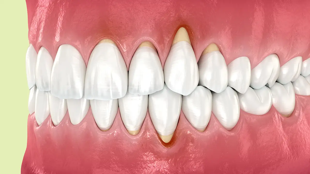 Perdita d’Osso nelle gengive – Studio Fiammenghi – Dentista Perdita d’Osso nelle gengive - Studio Fiammenghi - Dentista