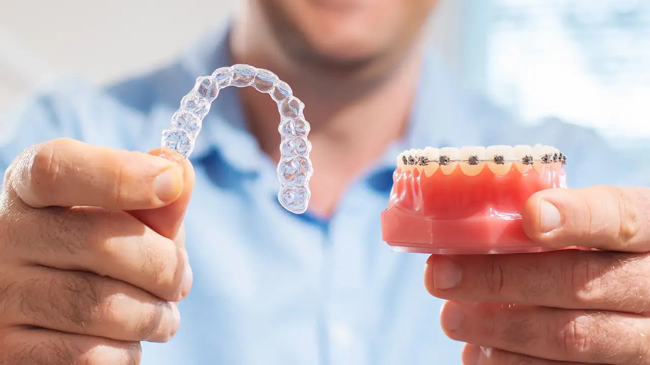 Allineatori trasparenti o apparecchio fisso – Studio Fiammenghi – Dentista Allineatori trasparenti o apparecchio fisso - Studio Fiammenghi - Dentista