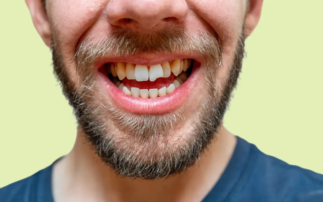 Cosa fare in caso di dente rotto: La guida Pratica dello Studio Dentistico Fiammenghi