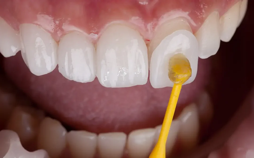 Faccette Dentali: Tutti i Vantaggi per Migliorare il Tuo Sorriso