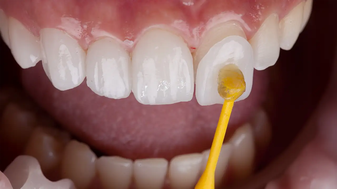 Faccette Dentali – Tutti i Vantaggi per Migliorare il Tuo Sorriso – Studio Fiammenghi – Dentista Faccette Dentali - Tutti i Vantaggi per Migliorare il Tuo Sorriso - Studio Fiammenghi - Dentista
