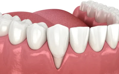 Recessione gengivale: come riconoscerla e curarla prima che peggiori