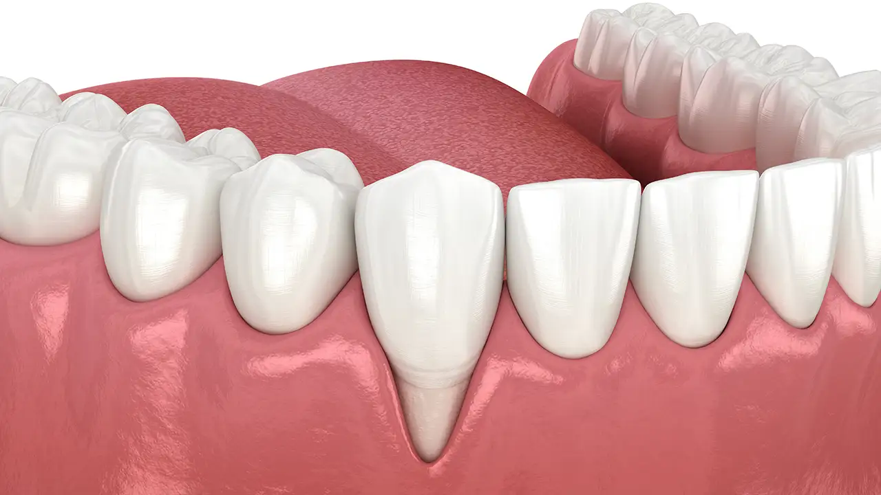 Recessione gengivale - come riconoscerla e curarla prima che peggiori - Studio Fiammenghi