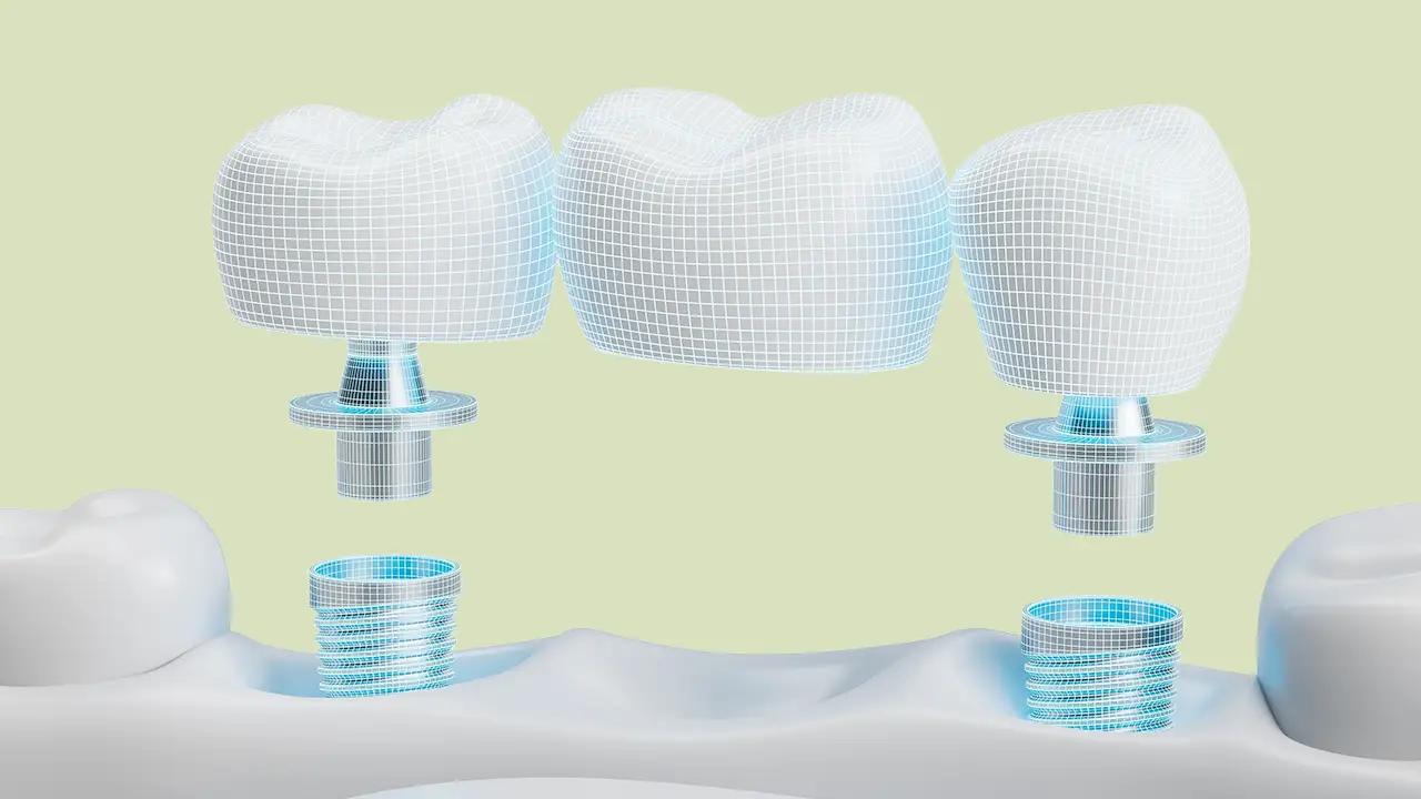 Implantologia moderna a Brescia - Studio Fiammenghi - Dentista