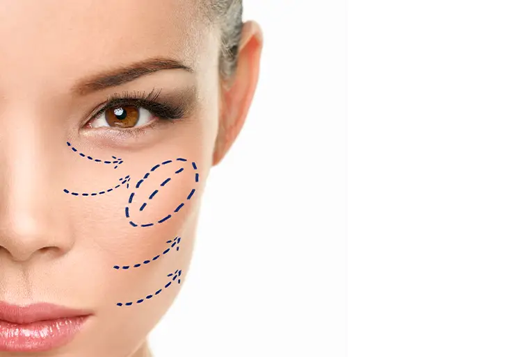 Fiammenghi - Filler Zigomi