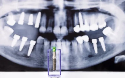 Denti fissi in giornata: guida completa all’implantologia a carico immediato