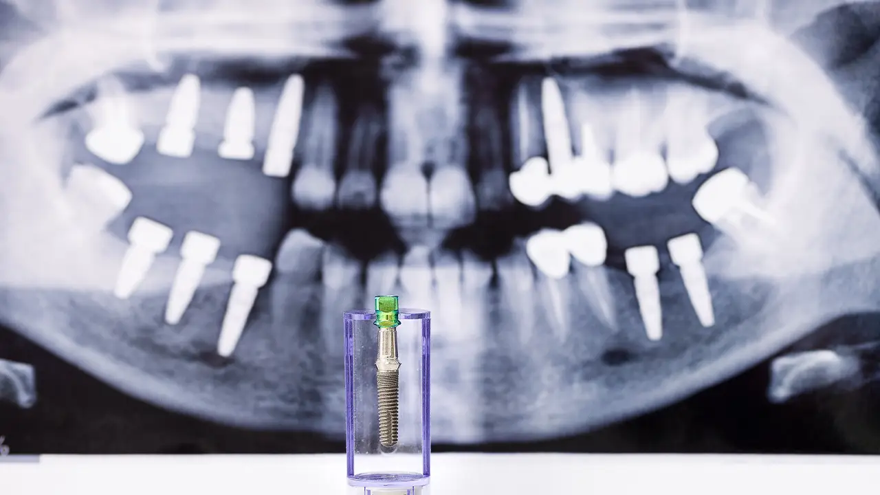 Studio Fiammenghi – Impianti dentali Studio Fiammenghi - Impianti dentali