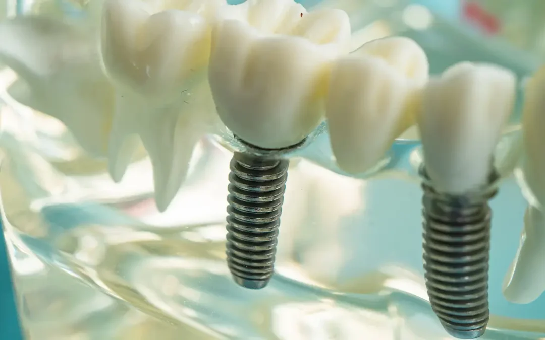 Mini-Impianti Dentali a Brescia: Quando Sono la Soluzione Ideale per Stabilizzare la Protesi Mobile