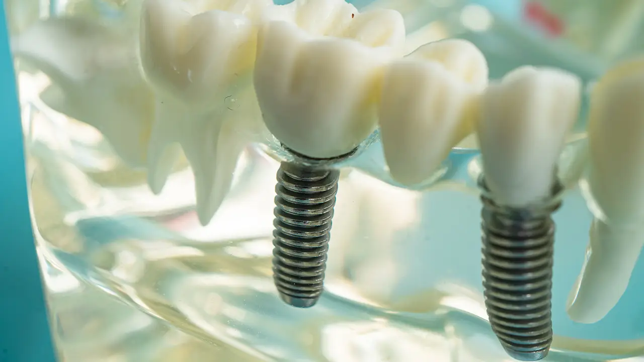 Fiammenghi – Mini impianti dentali Fiammenghi - Mini impianti dentali