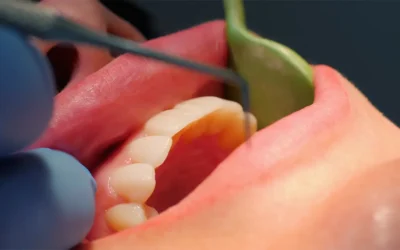 Parodontologia a Brescia: perché l’igiene orale professionale non è una semplice pulizia
