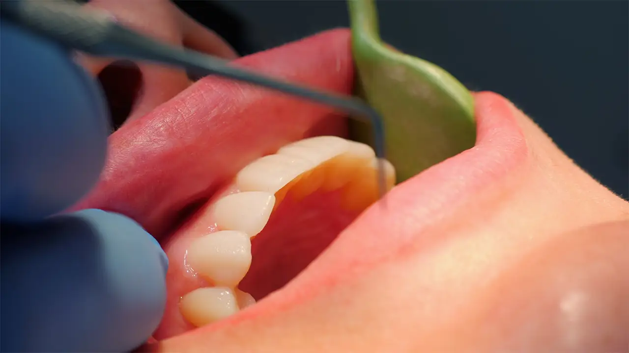 Fiammenghi – Parodontologia Fiammenghi - Parodontologia