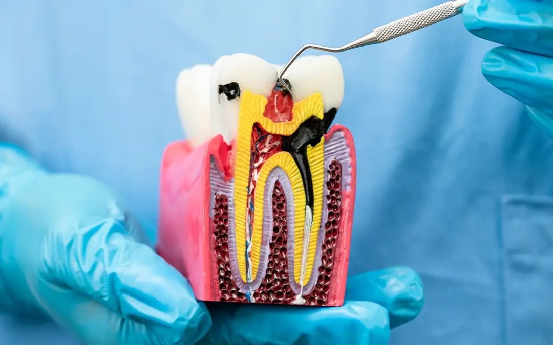 Trattamento della Carie Interdentale nei Bambini a Brescia: Il Restauro a Bassa Invasività per i Denti da Latte