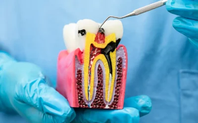 Trattamento della Carie Interdentale nei Bambini a Brescia: Il Restauro a Bassa Invasività per i Denti da Latte