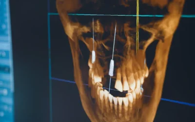 Impianti Zigomatici a Brescia: La Soluzione per Pazienti con Atrofia Mascellare Grave