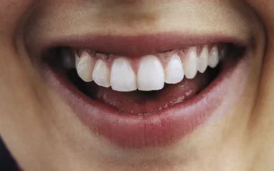 Ortodonzia linguale a Brescia: l’apparecchio invisibile davvero invisibile