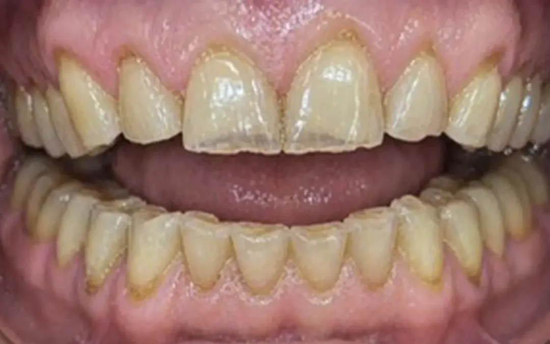 Usura dentale a Brescia: cause, sintomi e come proteggere i denti nel tempo