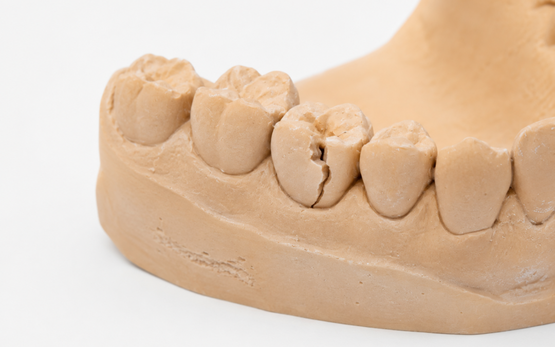 Dente Rotto, Consumato o Mancante: Come Scegliere la Soluzione Giusta Senza Errori