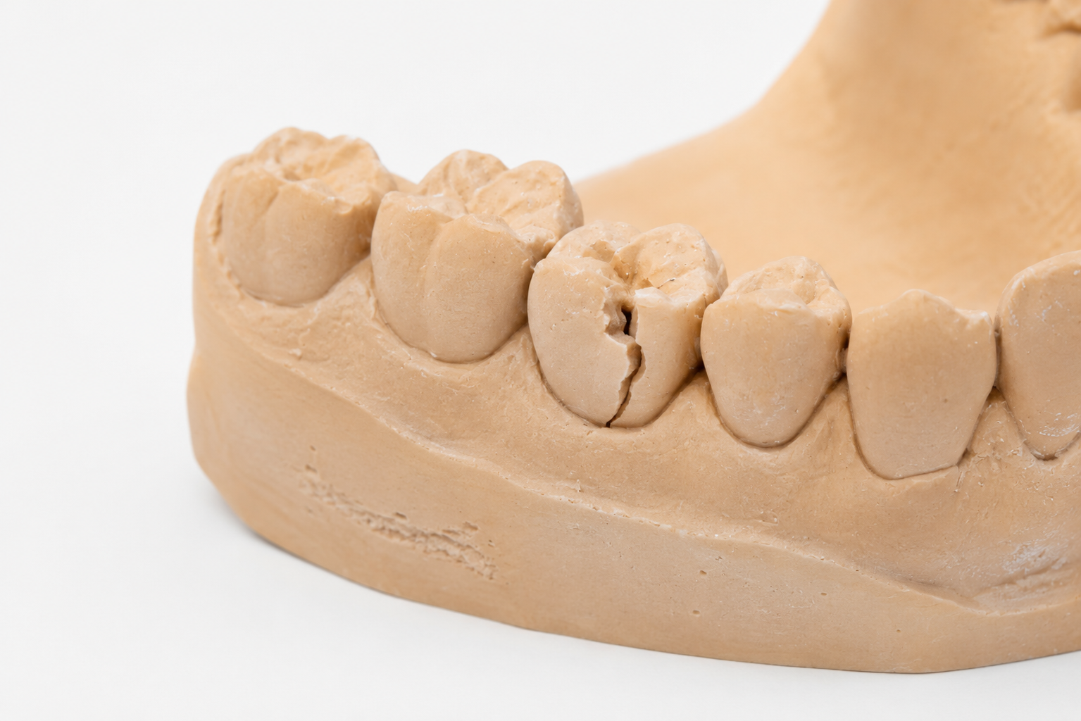 Studio dentistico Fiammenghi Brescia- dente rotto modello