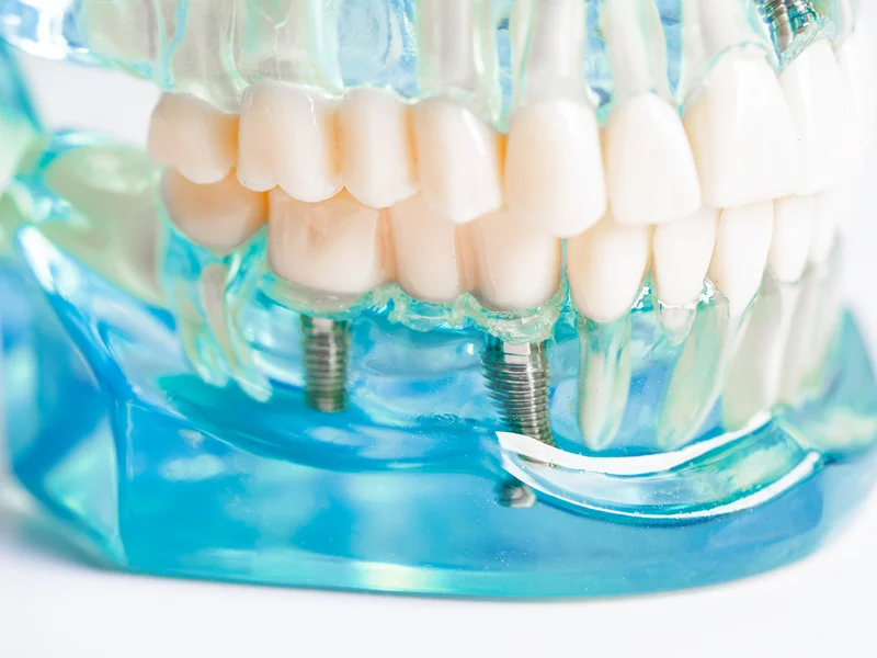 mockup di impianti dentali