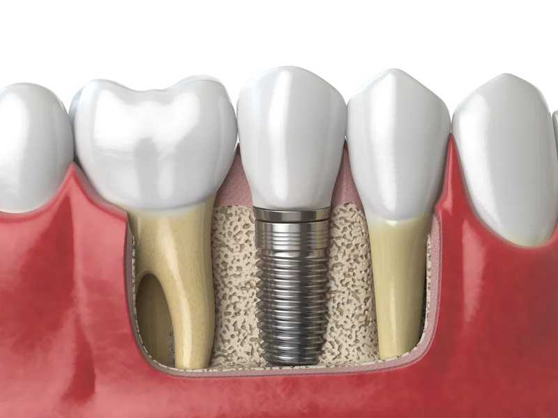 immagine 3d di un impianto dentale